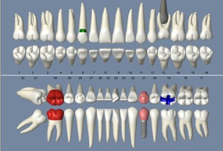 Open Dental Charting