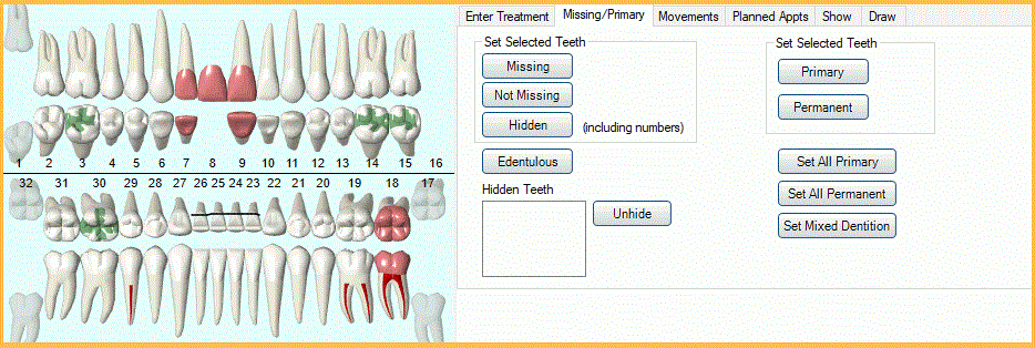 Open Dental Charting